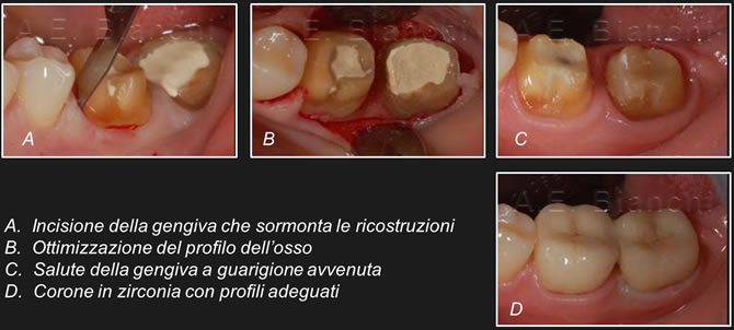 allungamento corona