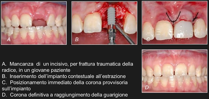 carico immediato