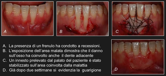 chirurgia dei frenuli