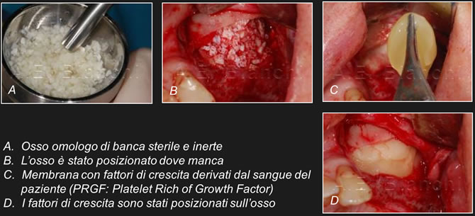 chirurgia rigenerativa