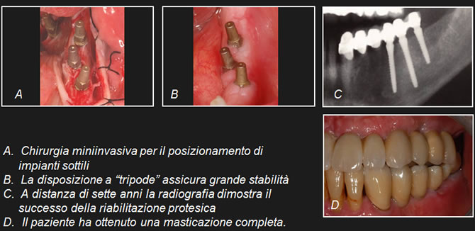 osso insufficiente