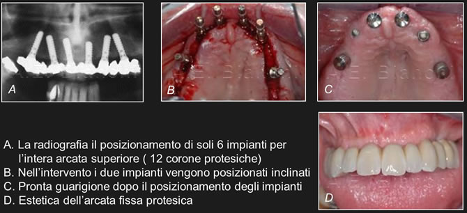 riabilitazioni implantari