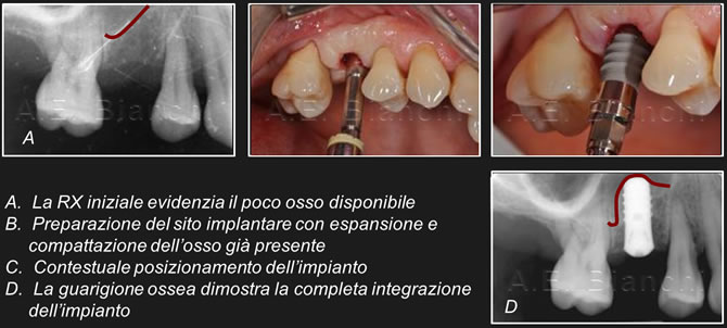 sinus lift