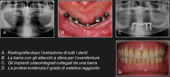 overdenture