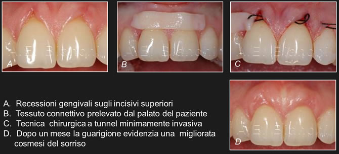 recessioni gengivali